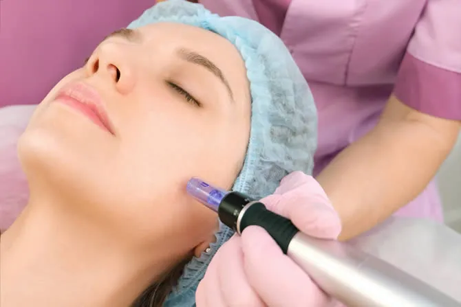 microneedling on face at dermatologist